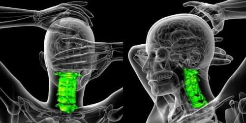 درمان آرتروز گردن: علت ساییدگی مهره های گردن