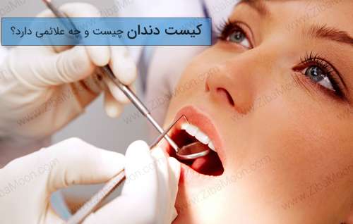 کیست دندان چیست و چه علائمی دارد؟