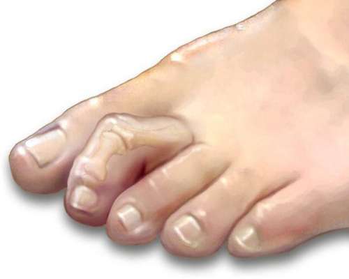 دلیل انگشت چکشی پا چیست و چطور درمان می شود؟