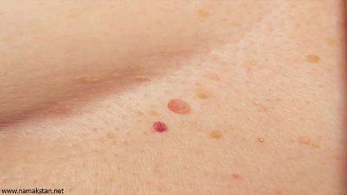سرطان پوست چیست؟ علائم و عوامل ایجاد سرطان پوست