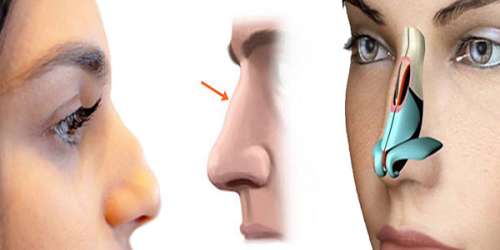 سوهان کشیدن بینی + مهمترین نکاتی که در مورد این روش جراحی بینی