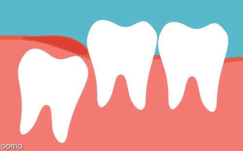 علائم عفونت بعد از کشیدن دندان عقل