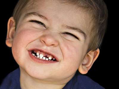 علت دندان قروچه کودکان و راههای درمان دندان قروچه