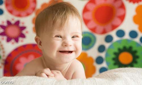 تشخیص سندرم داون در نوزاد