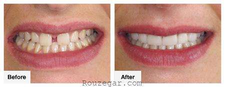 روش‌های مختلف زیبایی دندان