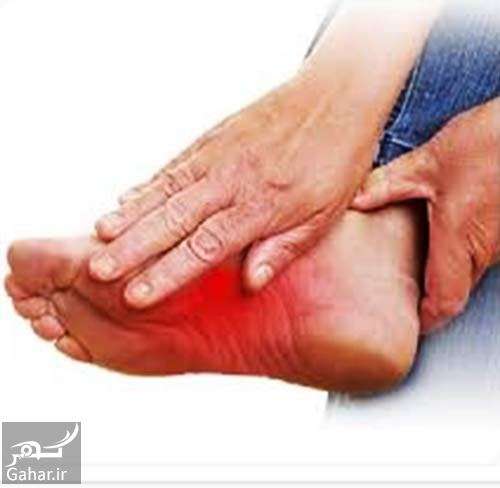 درمان داغی کف پا در تابستان و دیگر فصل ها