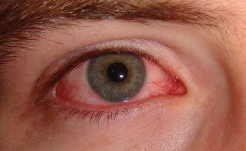 دلایل ایجاد بیماری چشم صورتی و علائم و راه درمان این بیماری