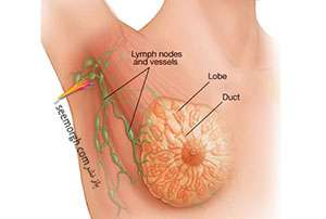 سرطان سینه چرا بروزمی کند و چه علائمی دارد؟ به مناسبت اکتبر، ماه آگاهی از سرطان سینه