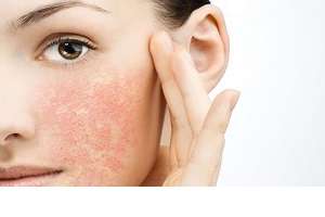عوامل تشدید کننده خشکی پوست