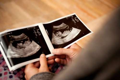 درصد اشتباه سونوگرافی در تشخیص جنسیت جنین دختر چقدر است؟