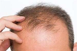 دلایل و روش درمان ریزش موی مرتبط با دیابت