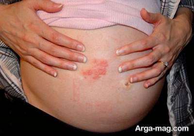 نشانه های زونا در بارداری و نحوه درمان آن
