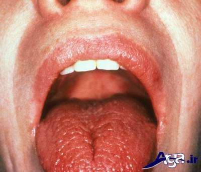 علت خشکی دهان چیست؟ و چگونه درمان می شود؟