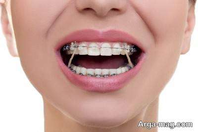 با مراحل سیم کشی دندان (ارتودنسی) آشنا شوید