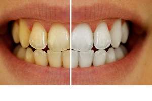 شیوه هایی بسیار ساده برای سفید کردن دندان ها