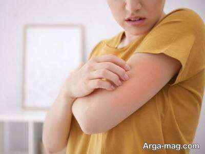 درمان جوش روی بازو ببا چند راهکار امتحان پس داده در خانه