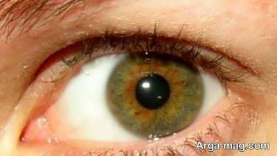 نشانه های التهاب چشم و راه های درمان تورم چشم ها