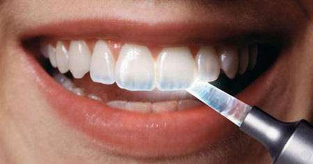 میناکاری دندان چیست و چگونه انجام می شود؟