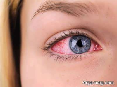 درمان خشکی چشم و علائم و نشانه های آن