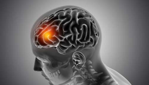 علائم و روش های درمان تومور مغزی مننژیوم