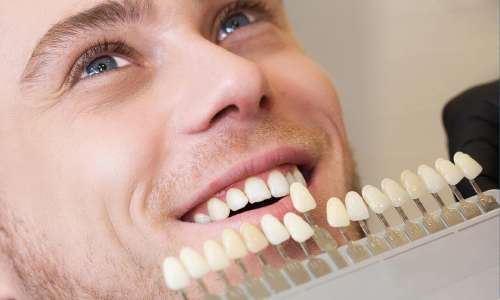 هزینه لمینت دندان چقدر است؟ مقایسه قیمت لمینت و قیمت کامپوزیت دندان