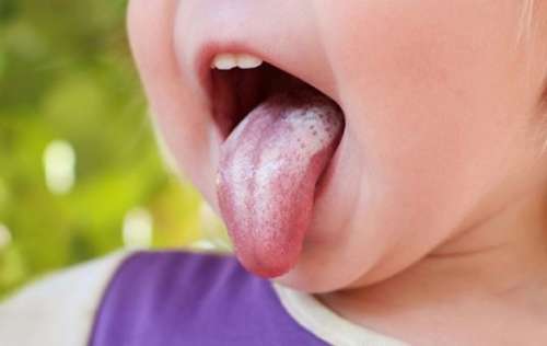 دهانشویه طبیعی و خانگی برای درمان برفک دهان