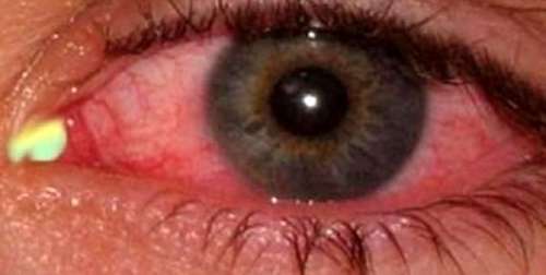 شایع‌ترین علائمی که کرونا در چشم‌ها ایجاد می‌کند