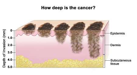 آشنایی با ملانوما خطرناک ترین سرطان پوست