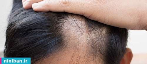 درمان ریزش سکه ای مو، ۵ روش مؤثر و کارآمد