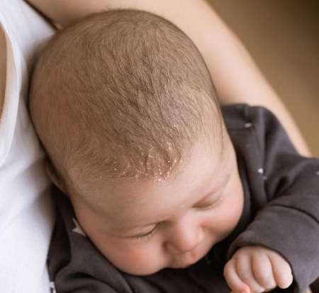 علل ، علایم و درمان کلاه گهواره یا بیماری درماتیت سبوره در نوزادان