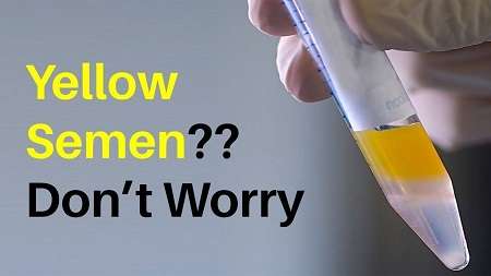زرد بودن مایع منی: پروستاتیت، بیماریهای مقاربتی، علل و درمان