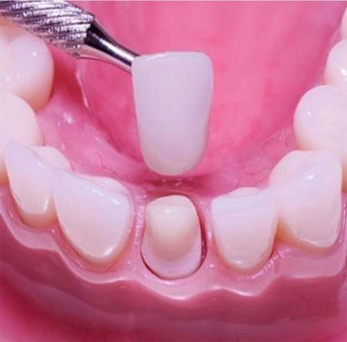 آشنایی با روش های کاشت دندان