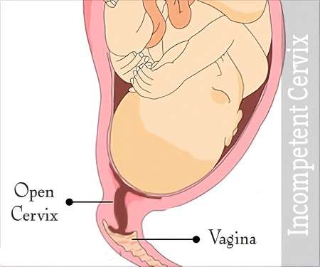 علل، علائم و روش های پیشگیری از نارسایی دهانه رحم در بارداری