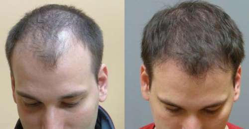 کاشت مو بدون جراحی با ۵ روش به نقل از کلینیک ترانسپلنت