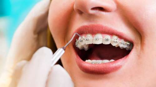سن طلایی برای ارتودنسی دندان