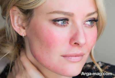 دلیل التهاب صورت و روش های مناسب درمان این عارضه پوستی