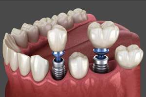 ایمپلنت فوری دندان چگونه انجام می‌شود؟