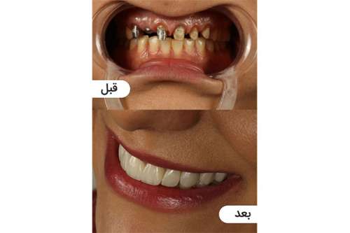 بهترین دکتر لمینت دندان در تهران کیست؟