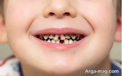جلوگیری از سیاهی دندان و معرفی دلایل بروز آن
