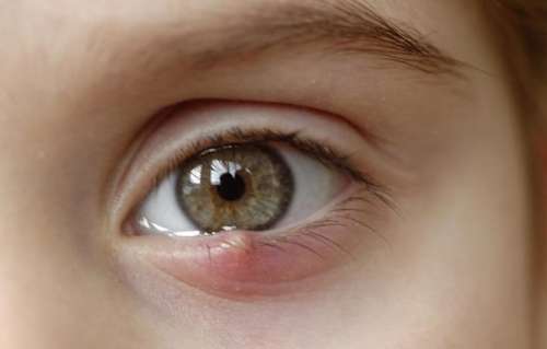 گل مژه چشم چیست؟ ۱۰ بهترین درمان های خانگی برای آن