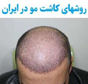 انواع روشهای کاشت مو در ایران [متد جدید]