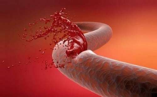 خونریزی داخلی چیست و چه نشانه هایی دارد و چطور درمان می شود؟