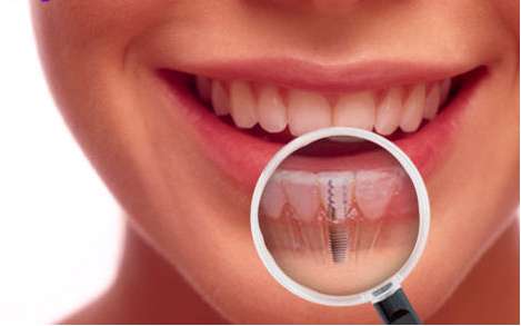 ویژگی های متخصص کاشت دندان و کامپوزیت دندان