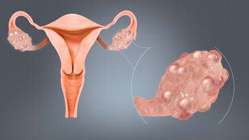 درمان تنبلی تخمدان چیست؟ تشخیص و نشانه­های آن