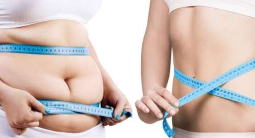 درباره جراحی چاقی بیشتر بدانید + مزایا و معایب عمل چاقی