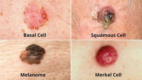 همه چیز درباره سرطان پوست | علل، انواع و روش های درمانی