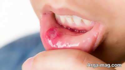 درمان تبخال داخل دهان با روش های طبیعی و خانگی