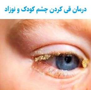 درمان قی کردن چشم کودک و نوزاد
