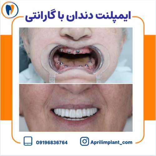 مزایا و فوائد ایمپلنت دندان چیست؟