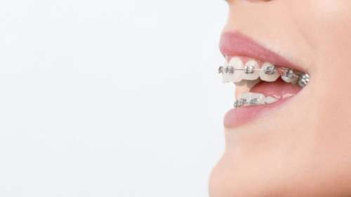 ارتودنسی دندان با اقساط بلند مدت در تابستان ۱۴۰۲